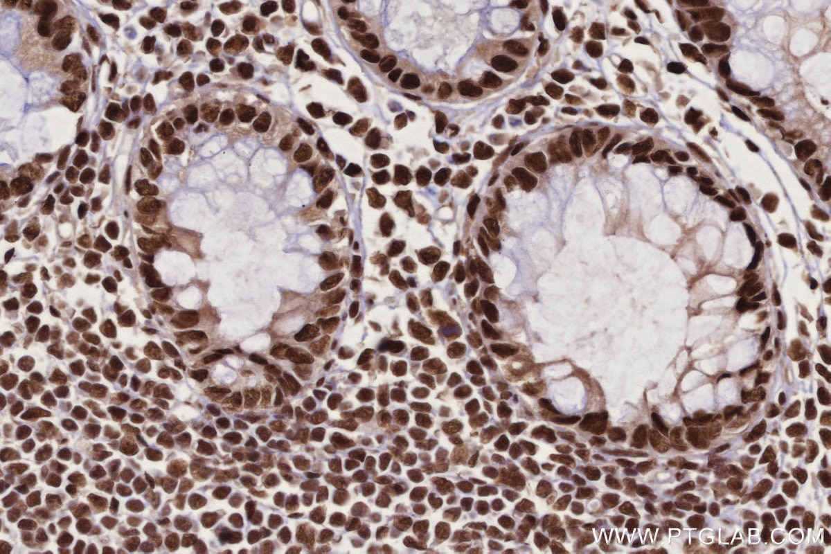 Immunohistochemistry (IHC) staining of human rectal cancer tissue using PSPC1 Polyclonal antibody (16714-1-AP)