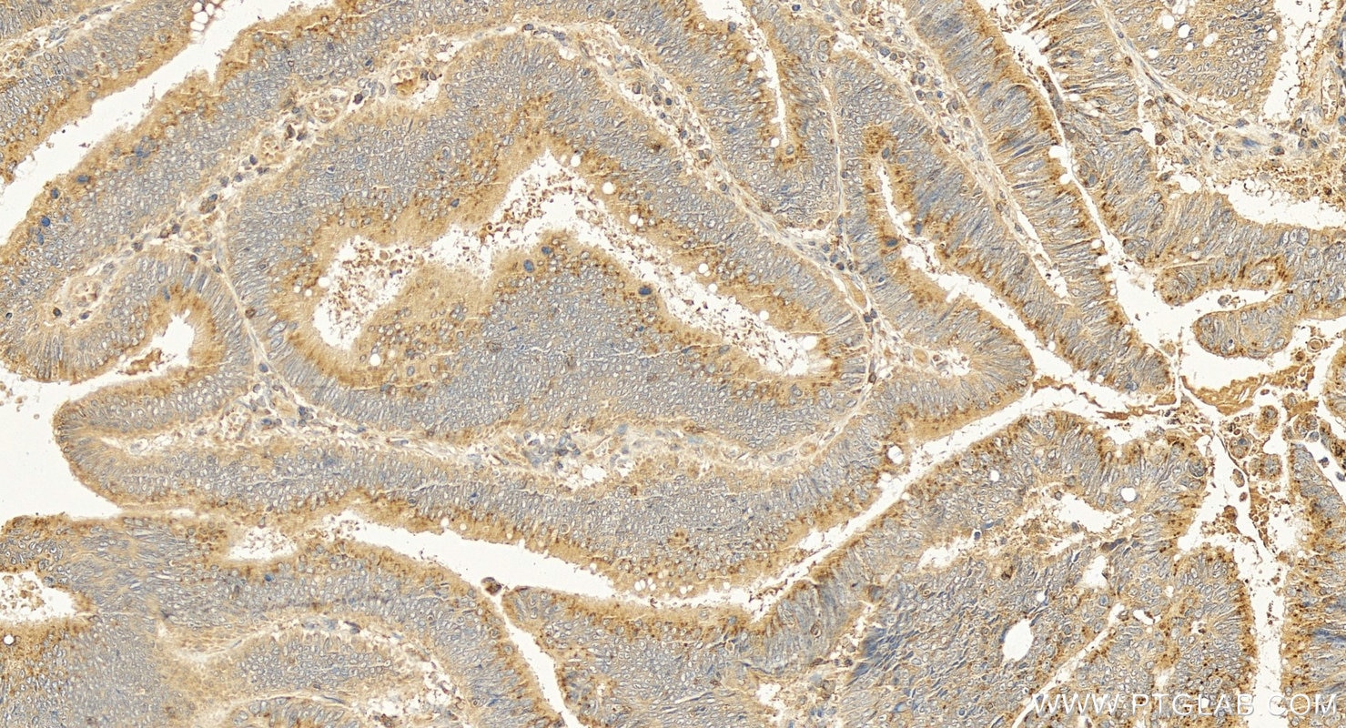 Immunohistochemistry (IHC) staining of human colon cancer tissue using persephin-Specific Polyclonal antibody (19713-1-AP)