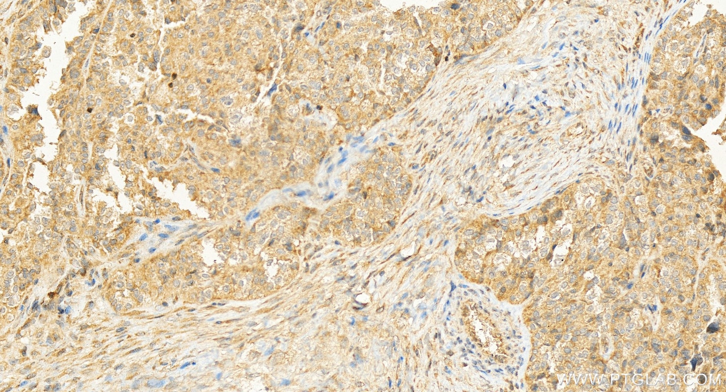 Immunohistochemistry (IHC) staining of human ovary cancer tissue using persephin-Specific Polyclonal antibody (19713-1-AP)