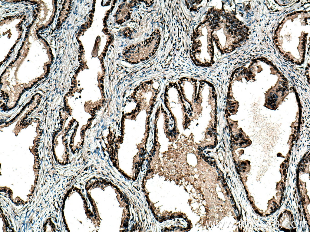 Immunohistochemistry (IHC) staining of human prostate cancer tissue using PTBP1 Polyclonal antibody (12582-1-AP)