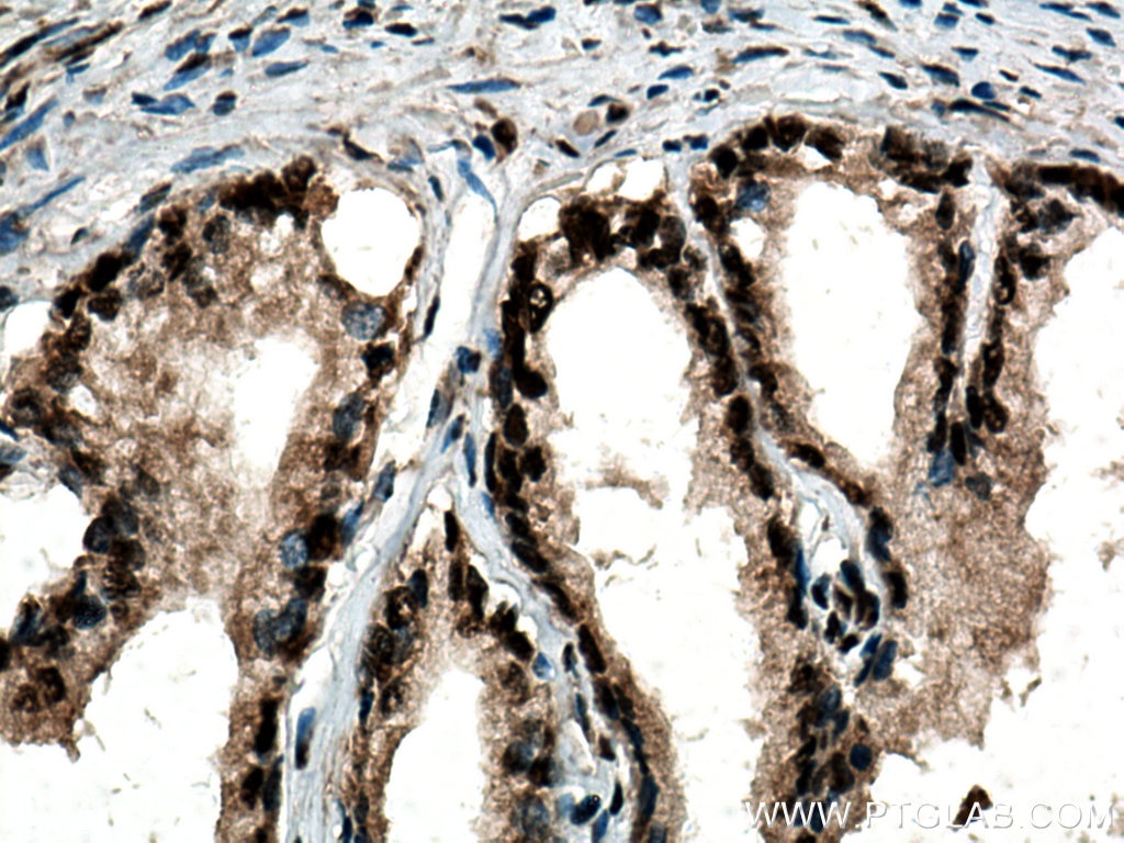 Immunohistochemistry (IHC) staining of human prostate cancer tissue using PTBP1 Polyclonal antibody (12582-1-AP)