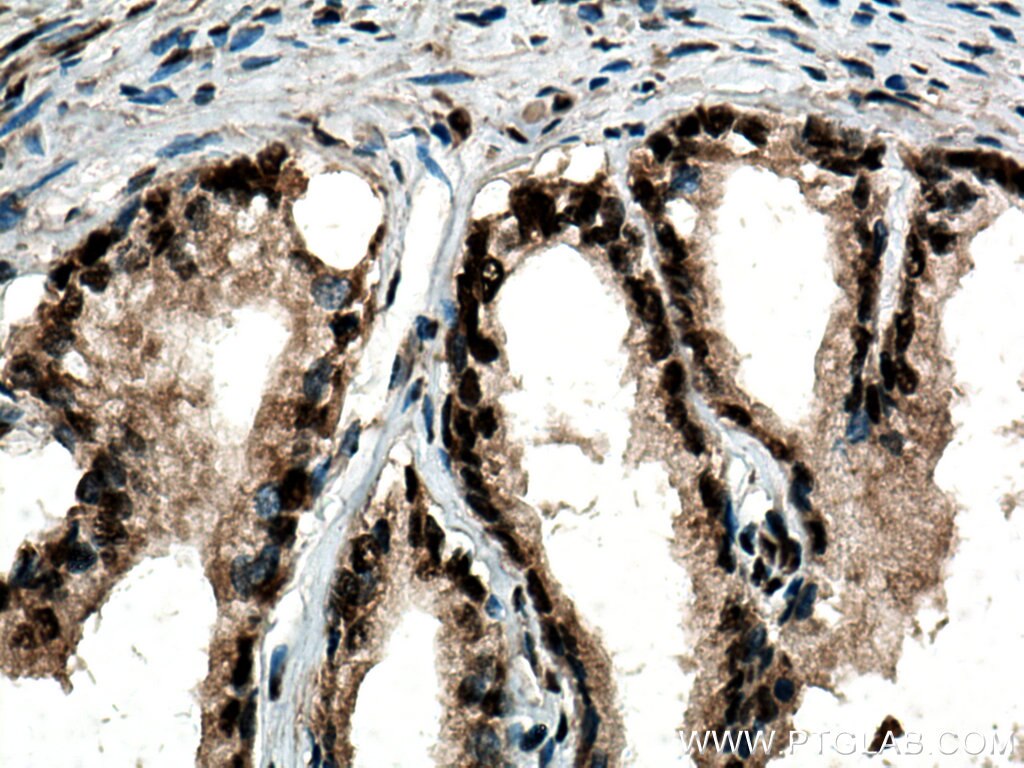 IHC staining of human prostate cancer using 12582-1-AP