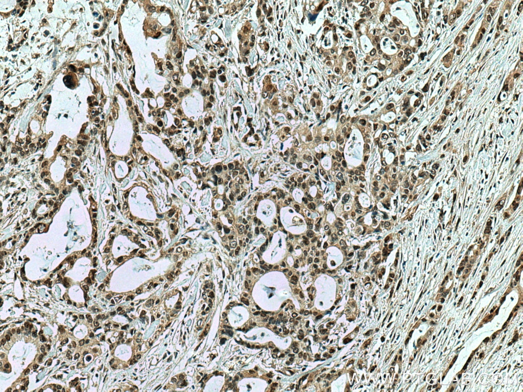 Immunohistochemistry (IHC) staining of human pancreas cancer tissue using PTBP1 Monoclonal antibody (67462-1-Ig)