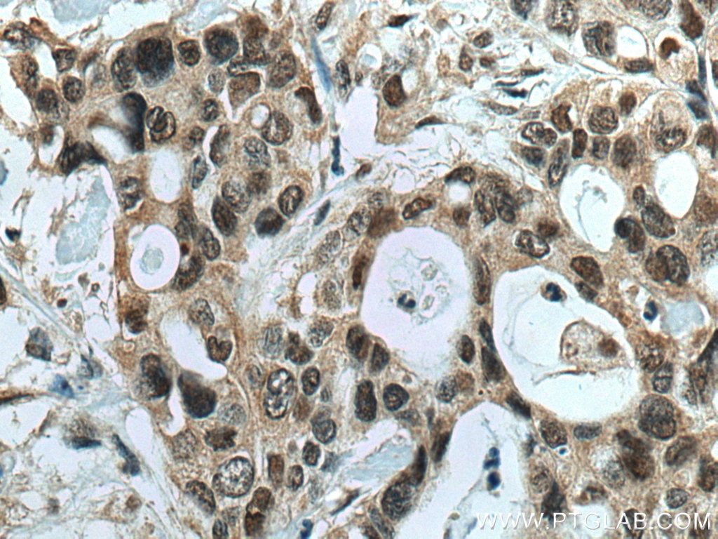 Immunohistochemistry (IHC) staining of human pancreas cancer tissue using PTBP1 Monoclonal antibody (67462-1-Ig)