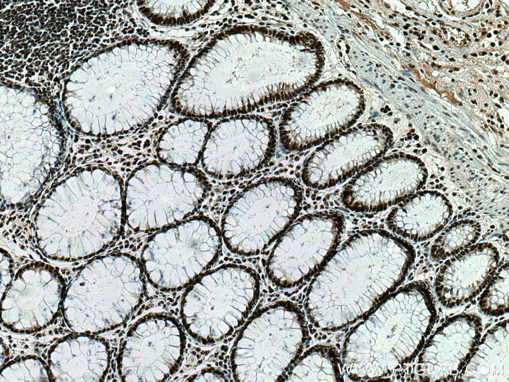 Immunohistochemistry (IHC) staining of human colon cancer tissue using PTBP1 Monoclonal antibody (67462-1-Ig)