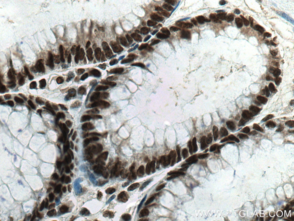 Immunohistochemistry (IHC) staining of human colon cancer tissue using PTBP1 Monoclonal antibody (67462-1-Ig)