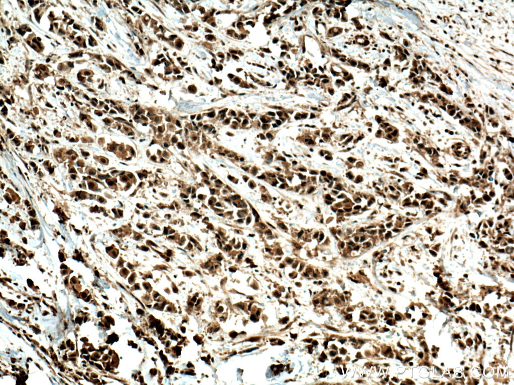 Immunohistochemistry (IHC) staining of human breast cancer tissue using PTEN Polyclonal antibody (10047-1-AP)