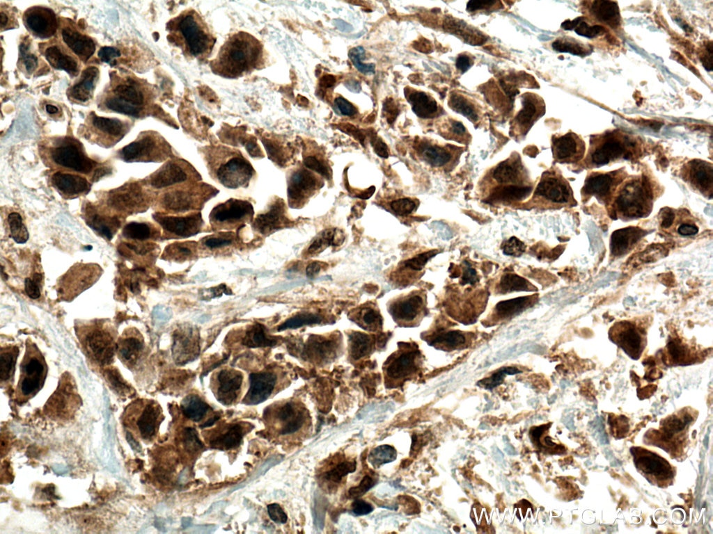 Immunohistochemistry (IHC) staining of human breast cancer tissue using PTEN Polyclonal antibody (10047-1-AP)