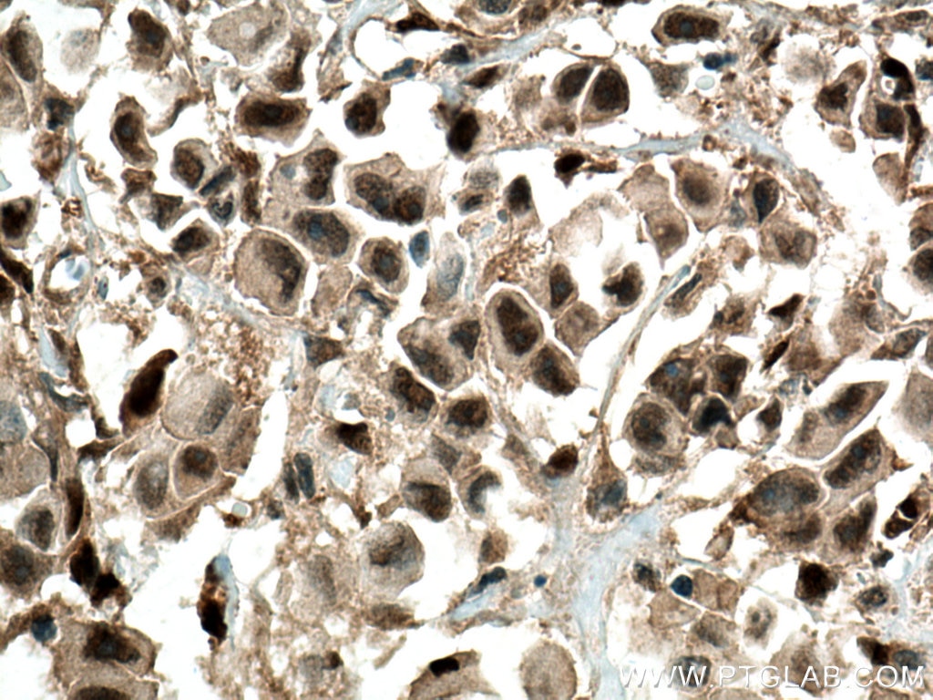 Immunohistochemistry (IHC) staining of human breast cancer tissue using PTEN Polyclonal antibody (22034-1-AP)