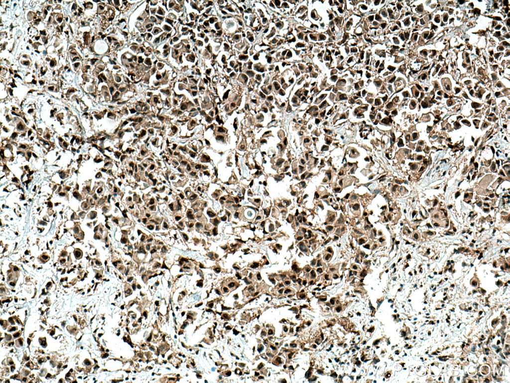 Immunohistochemistry (IHC) staining of human breast cancer tissue using PTEN Polyclonal antibody (22034-1-AP)