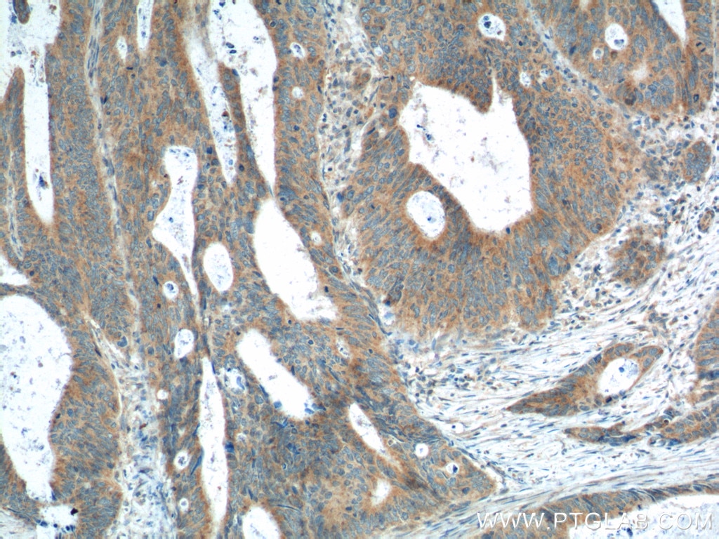 Immunohistochemistry (IHC) staining of human colon cancer tissue using PTEN Polyclonal antibody (22034-1-AP)