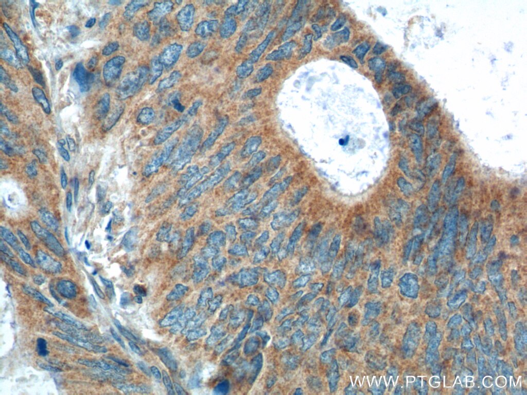 Immunohistochemistry (IHC) staining of human colon cancer tissue using PTEN Polyclonal antibody (22034-1-AP)