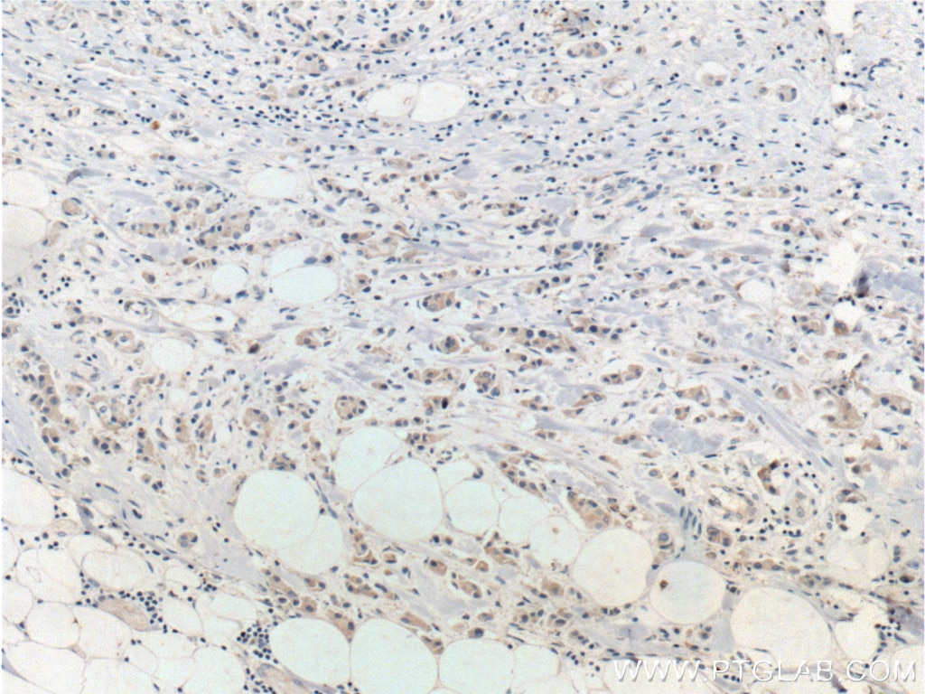 Immunohistochemistry (IHC) staining of human breast cancer tissue using PTEN Polyclonal antibody (22034-1-AP)