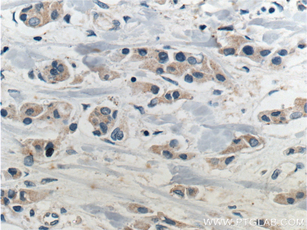 Immunohistochemistry (IHC) staining of human breast cancer tissue using PTEN Polyclonal antibody (22034-1-AP)