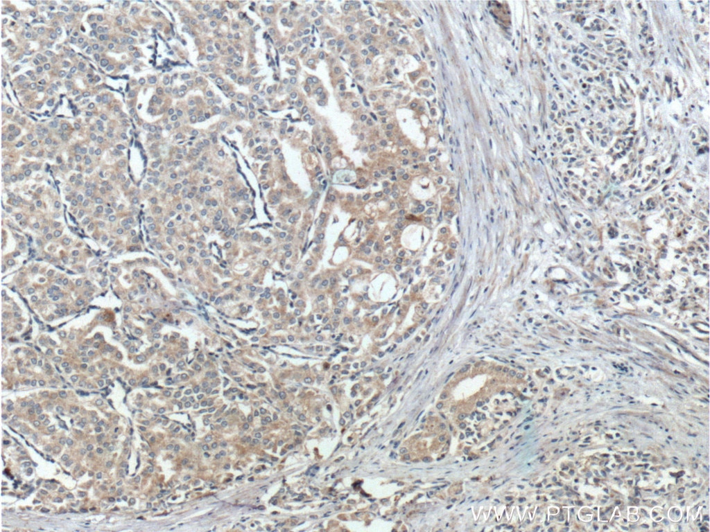 Immunohistochemistry (IHC) staining of human prostate cancer tissue using PTEN Polyclonal antibody (22034-1-AP)