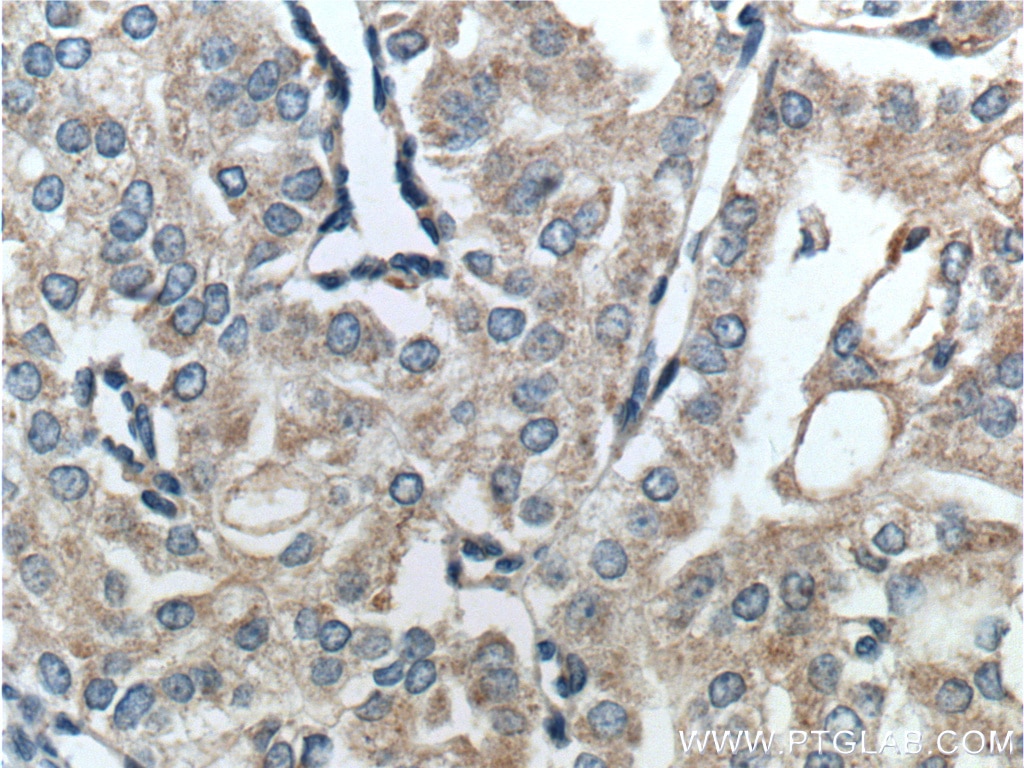 Immunohistochemistry (IHC) staining of human prostate cancer tissue using PTEN Polyclonal antibody (22034-1-AP)