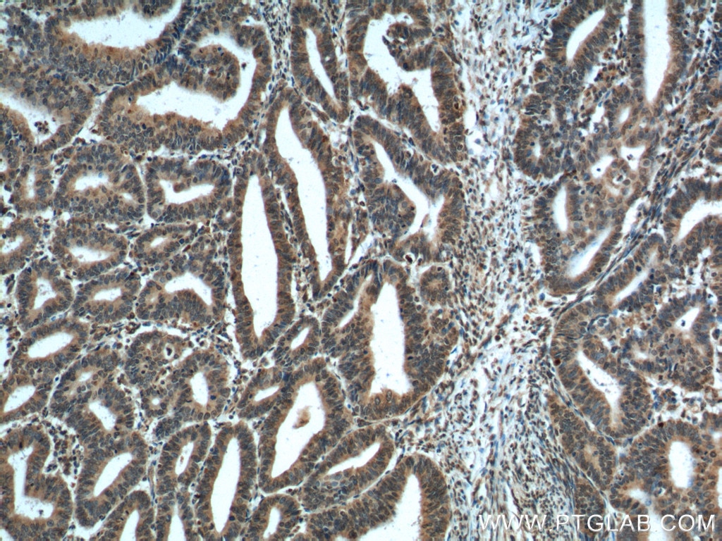 IHC staining of human endometrial cancer using 60300-1-Ig