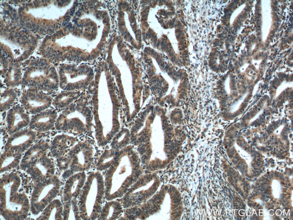 Immunohistochemistry (IHC) staining of human endometrial cancer tissue using PTEN Monoclonal antibody (60300-1-Ig)