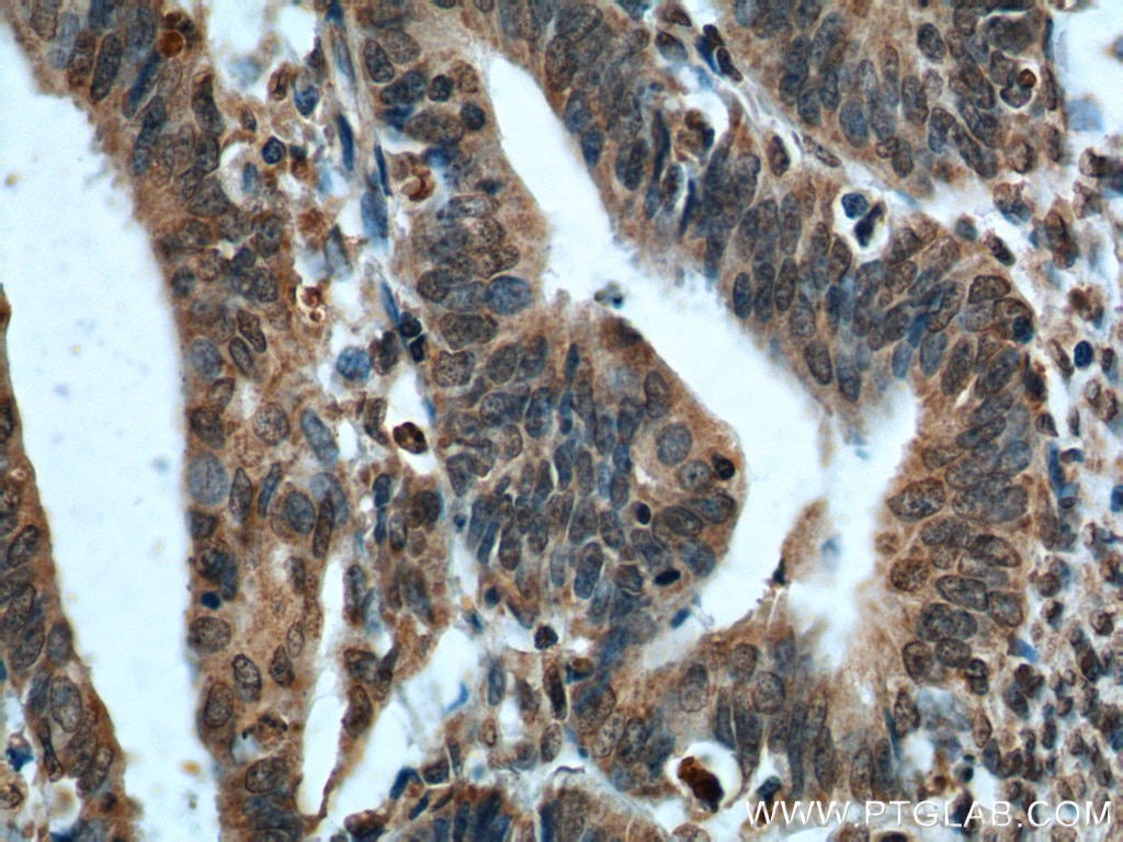 Immunohistochemistry (IHC) staining of human endometrial cancer tissue using PTEN Monoclonal antibody (60300-1-Ig)