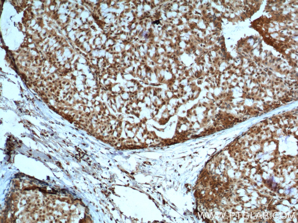 IHC staining of human breast hyperplasia using 60300-1-Ig