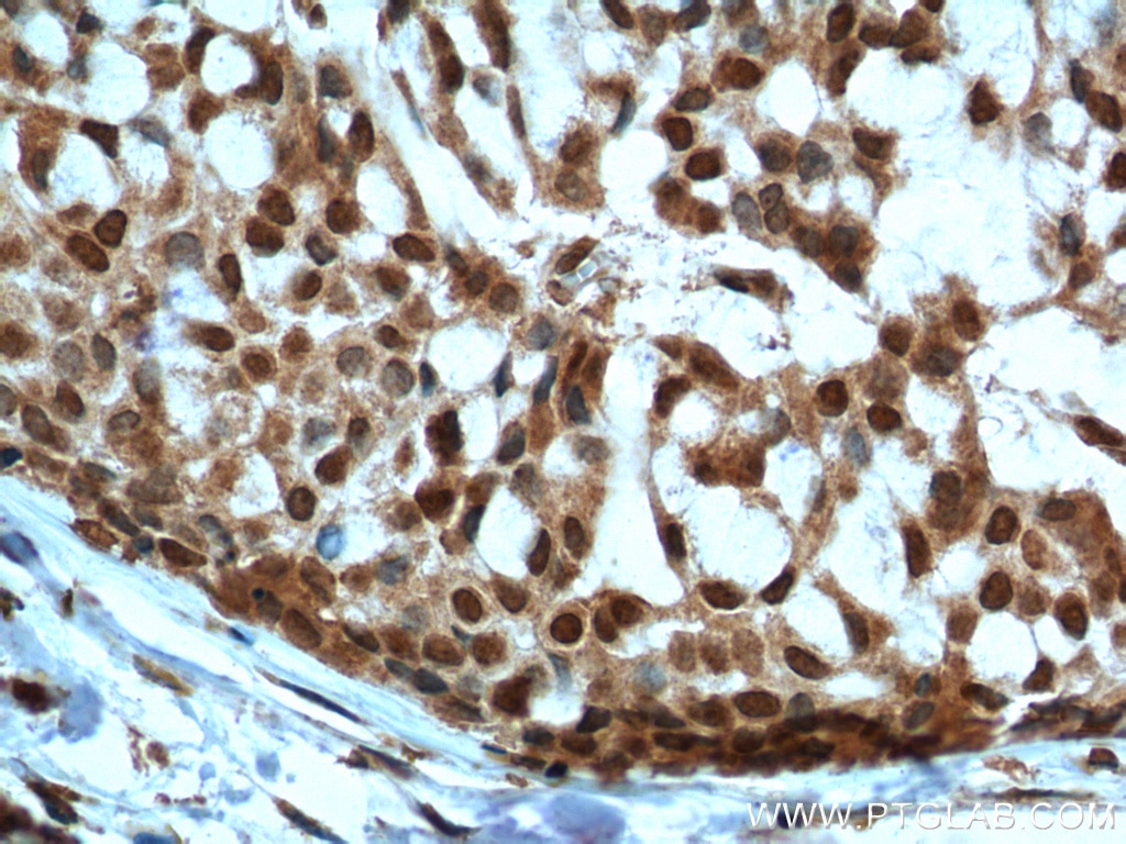 Immunohistochemistry (IHC) staining of human breast hyperplasia tissue using PTEN Monoclonal antibody (60300-1-Ig)