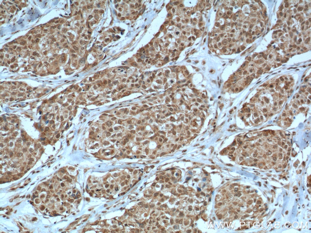 IHC staining of human lung cancer using 60300-1-Ig