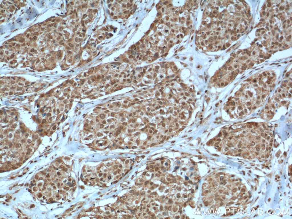 Immunohistochemistry (IHC) staining of human lung cancer tissue using PTEN Monoclonal antibody (60300-1-Ig)