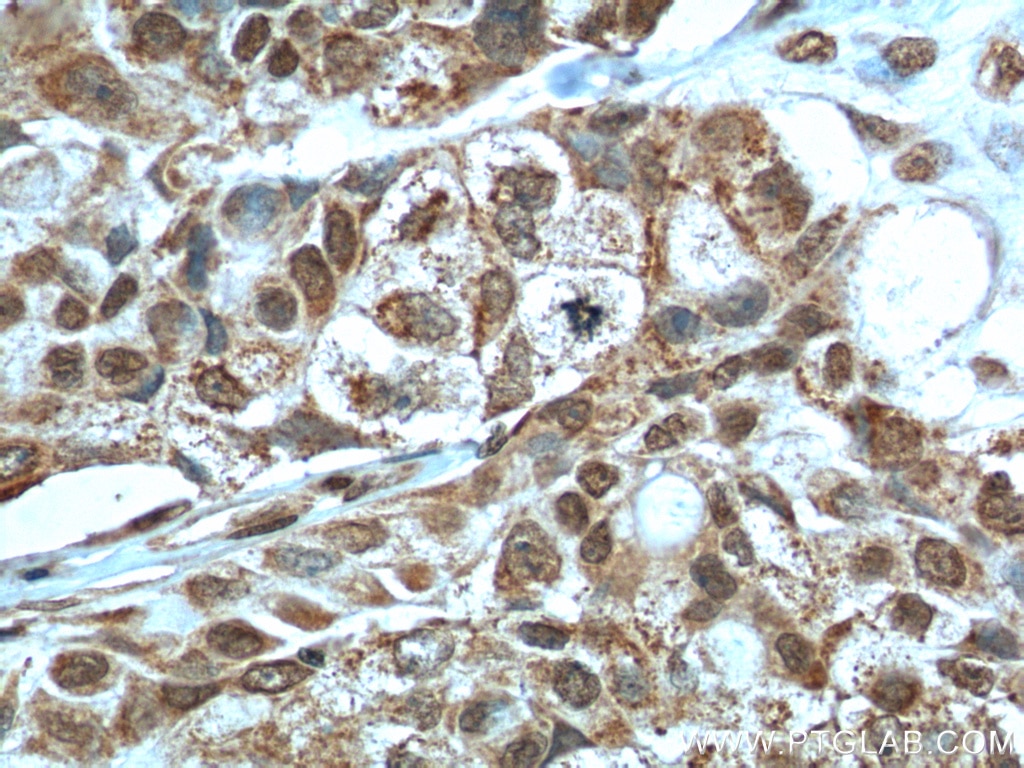 Immunohistochemistry (IHC) staining of human lung cancer tissue using PTEN Monoclonal antibody (60300-1-Ig)