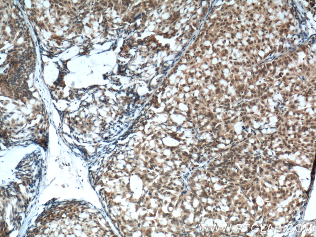 Immunohistochemistry (IHC) staining of human breast hyperplasia tissue using PTEN Monoclonal antibody (60300-1-Ig)