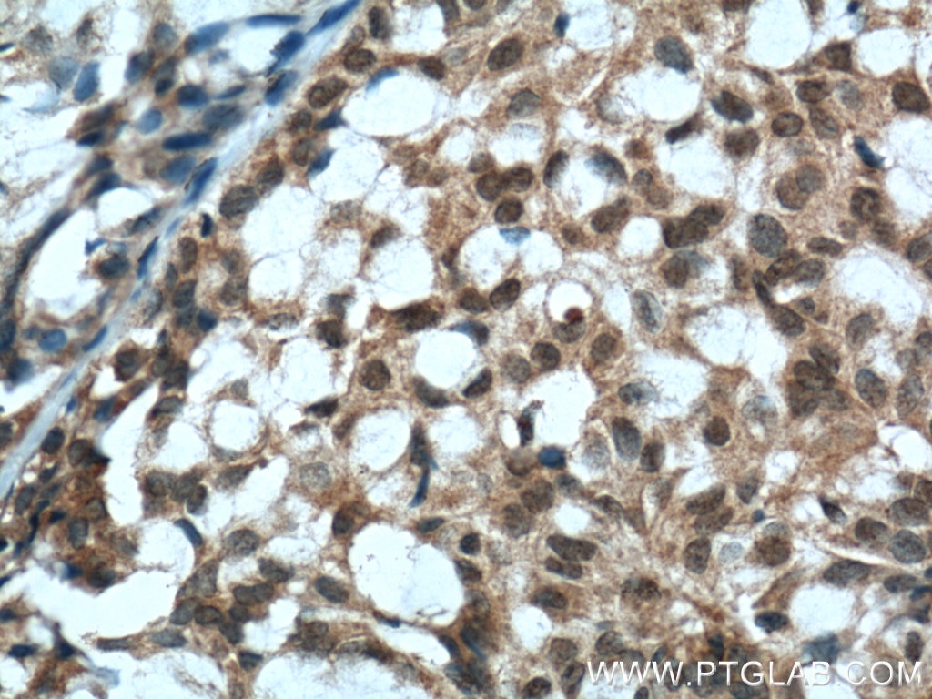 Immunohistochemistry (IHC) staining of human breast hyperplasia tissue using PTEN Monoclonal antibody (60300-1-Ig)