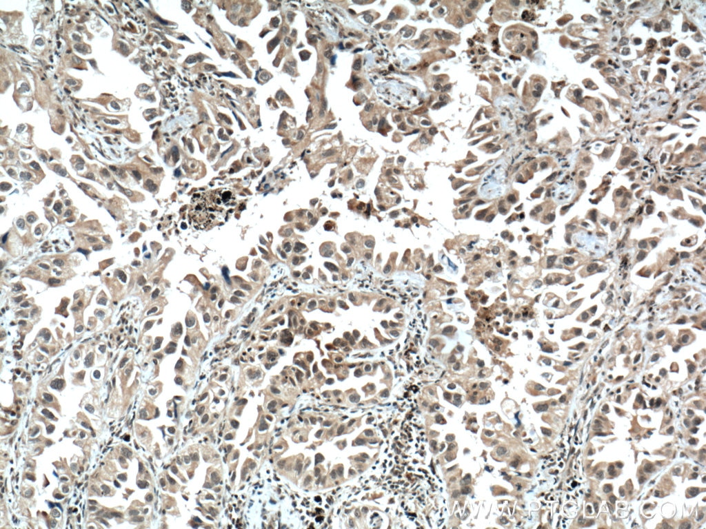 Immunohistochemistry (IHC) staining of human lung cancer tissue using PTEN Monoclonal antibody (60300-1-Ig)