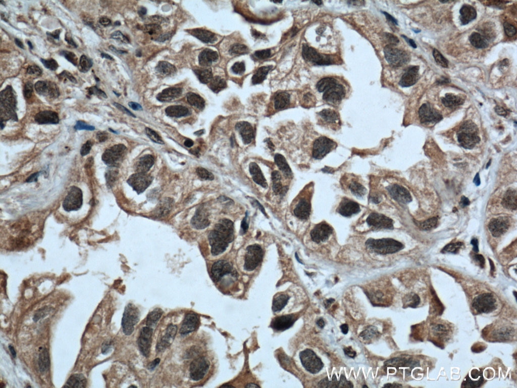 Immunohistochemistry (IHC) staining of human lung cancer tissue using PTEN Monoclonal antibody (60300-1-Ig)