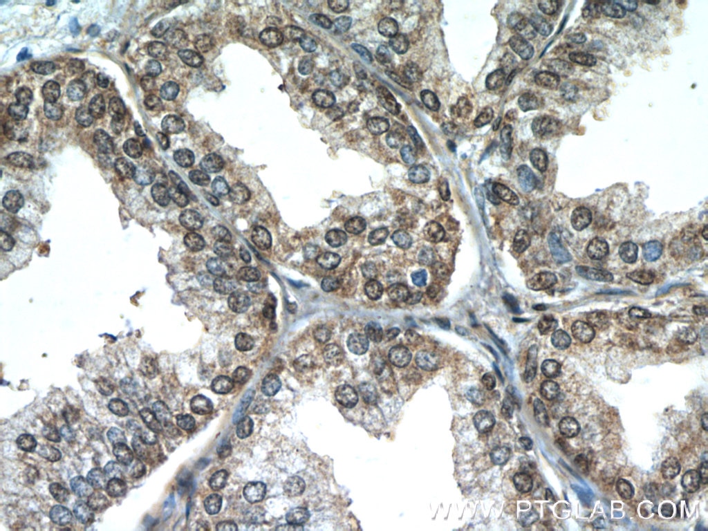 Immunohistochemistry (IHC) staining of human prostate hyperplasia tissue using PTEN Monoclonal antibody (60300-1-Ig)