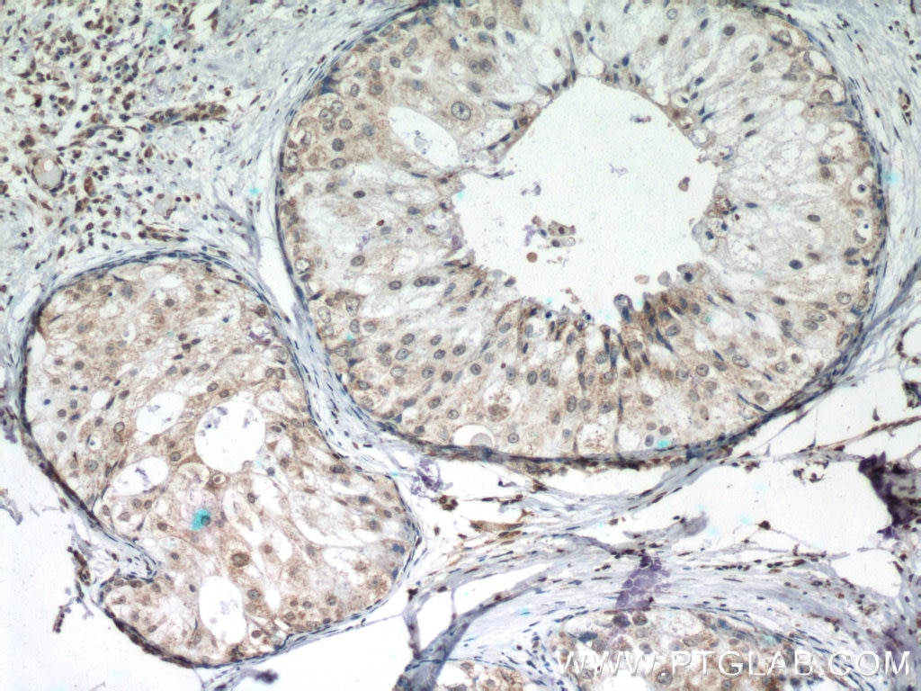 IHC staining of human breast cancer using 60300-1-Ig