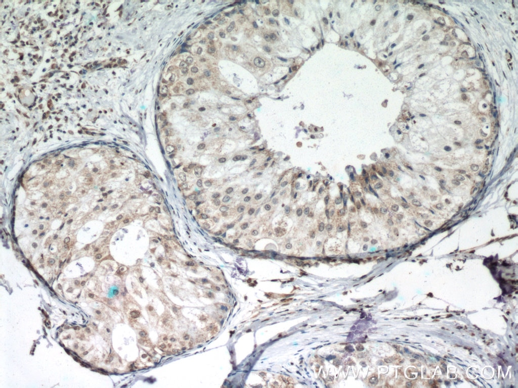 Immunohistochemistry (IHC) staining of human breast cancer tissue using PTEN Monoclonal antibody (60300-1-Ig)