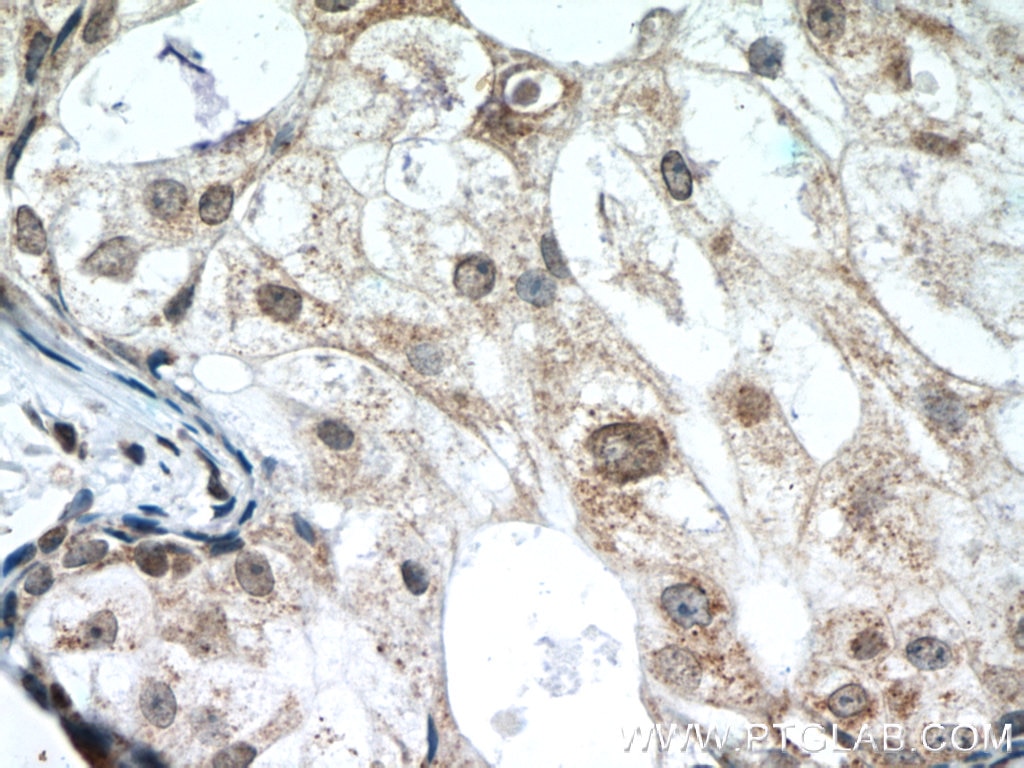 IHC staining of human breast cancer using 60300-1-Ig