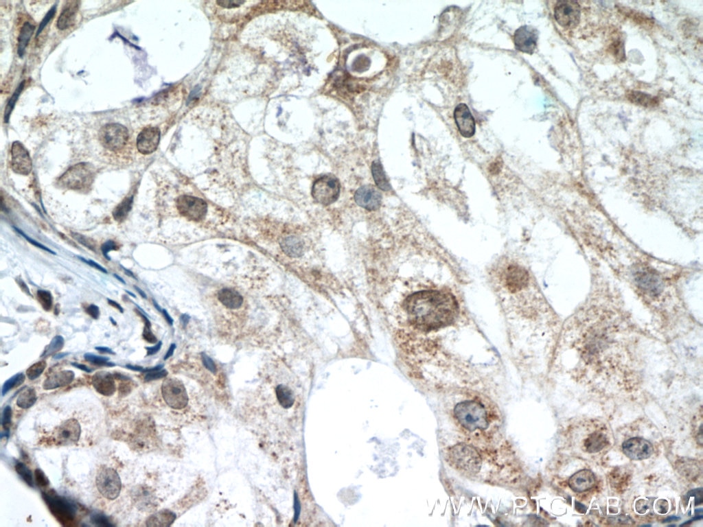 Immunohistochemistry (IHC) staining of human breast cancer tissue using PTEN Monoclonal antibody (60300-1-Ig)