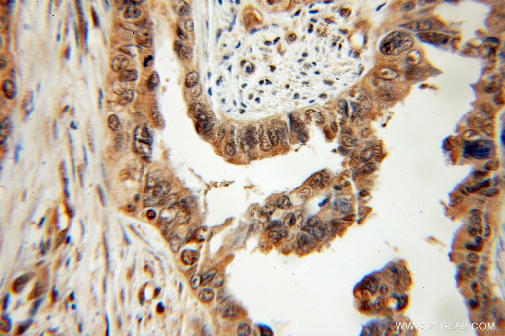 Immunohistochemistry (IHC) staining of human ovary tumor tissue using PTER Polyclonal antibody (11191-1-AP)