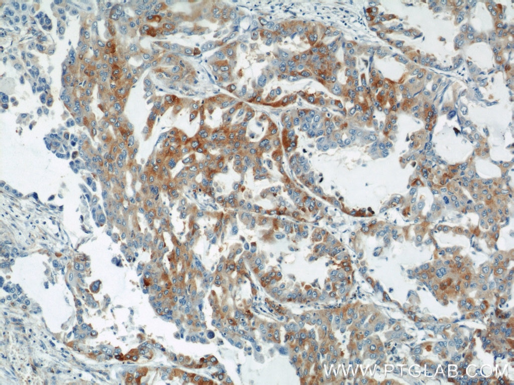 Immunohistochemistry (IHC) staining of human lung cancer tissue using PTGDS Polyclonal antibody (10754-2-AP)