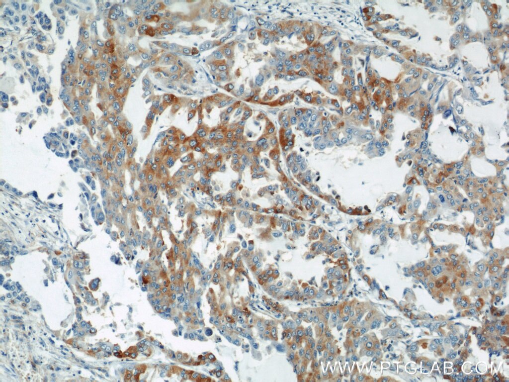 IHC staining of human lung cancer using 10754-2-AP