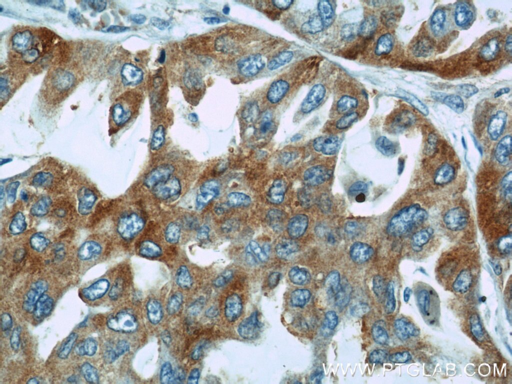 Immunohistochemistry (IHC) staining of human lung cancer tissue using PTGDS Polyclonal antibody (10754-2-AP)