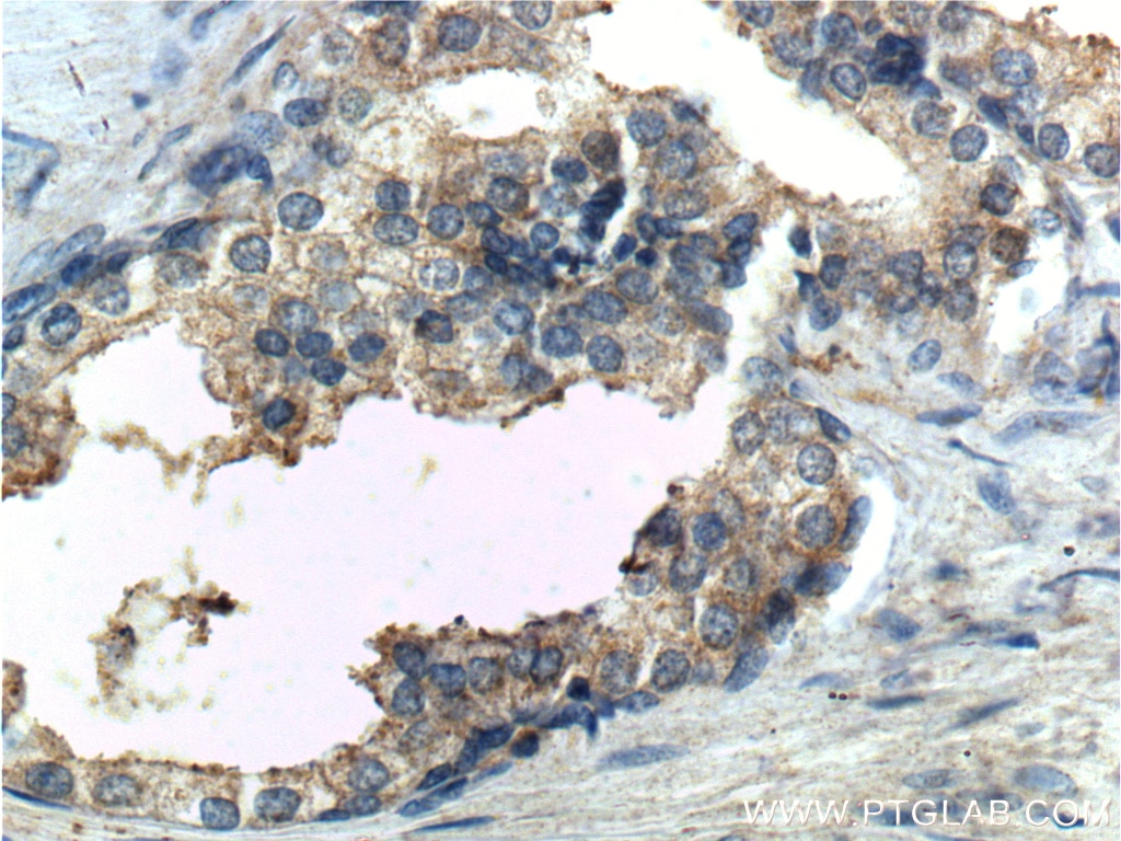 IHC staining of human prostate hyperplasia using 24895-1-AP