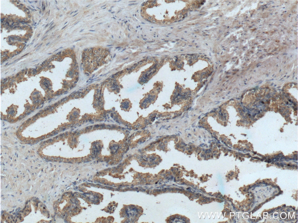 IHC staining of human prostate hyperplasia using 24895-1-AP