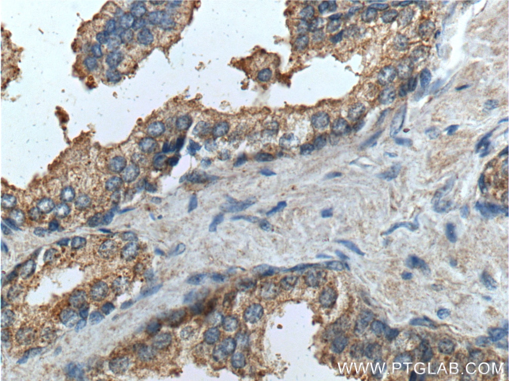 Immunohistochemistry (IHC) staining of human prostate hyperplasia tissue using PTGER4 Polyclonal antibody (24895-1-AP)