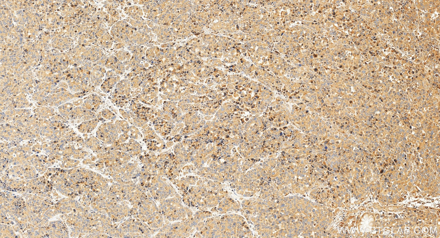 IHC staining of human stomach cancer using 10596-1-AP Immunohistochemistry (IHC) staining of human stomach cancer tissue using PTGES Polyclonal antibody (10596-1-AP)