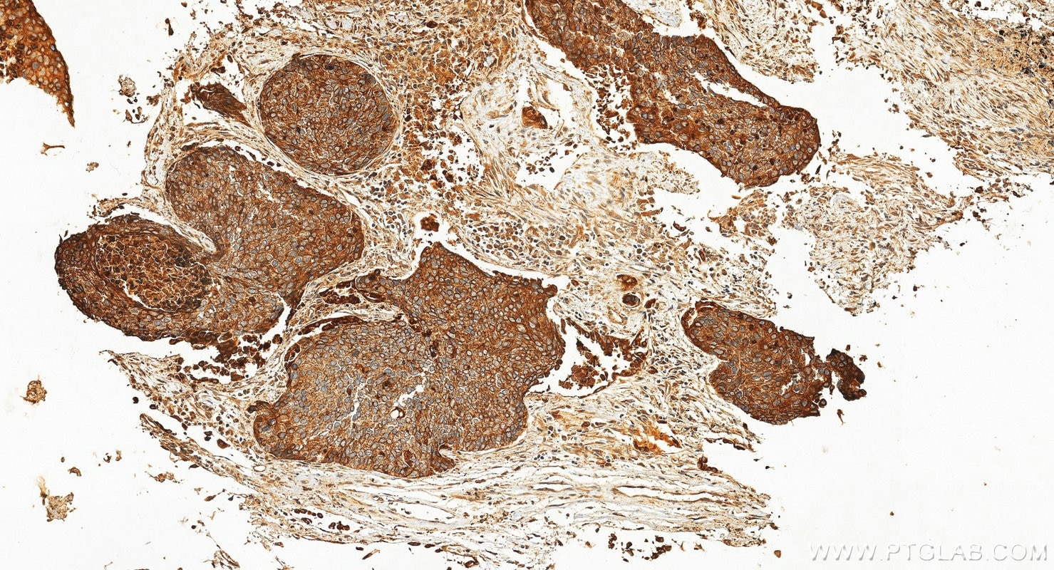 IHC staining of human lung cancer using 10596-1-AP Immunohistochemistry (IHC) staining of human lung cancer tissue using PTGES Polyclonal antibody (10596-1-AP)