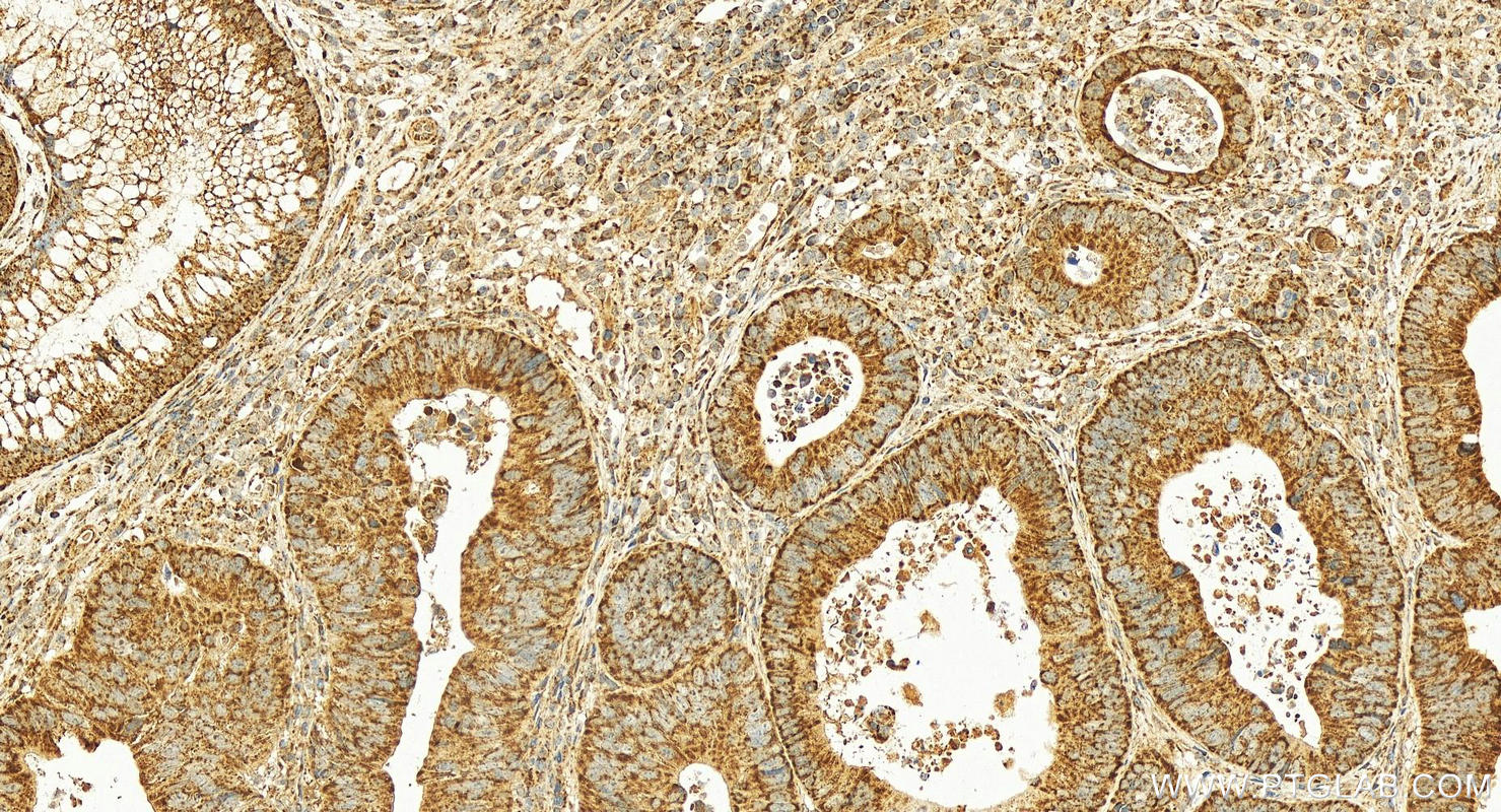 Immunohistochemistry (IHC) staining of human colon cancer tissue using PTGES2 Polyclonal antibody (10881-1-AP)