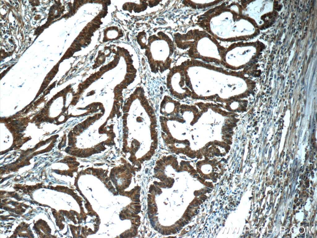 Immunohistochemistry (IHC) staining of human colon cancer tissue using PTGES2 Polyclonal antibody (10881-1-AP)