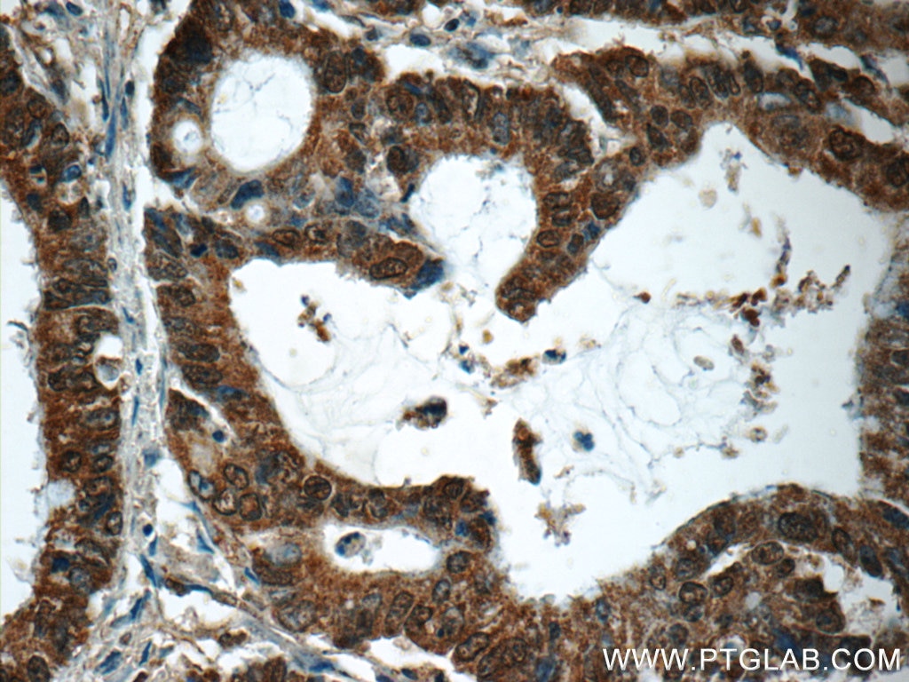 Immunohistochemistry (IHC) staining of human colon cancer tissue using PTGES2 Polyclonal antibody (10881-1-AP)