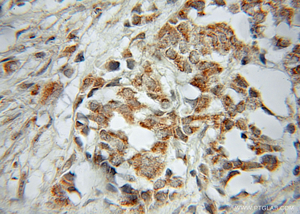 Immunohistochemistry (IHC) staining of human breast cancer tissue using PTGES2 Polyclonal antibody (10881-1-AP)